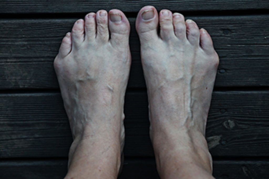 Facts About Bunions and Bunionettes