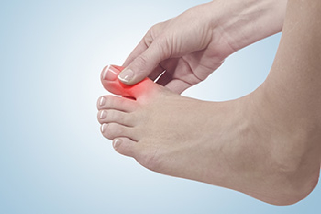 Living With Chronic Gout Pain