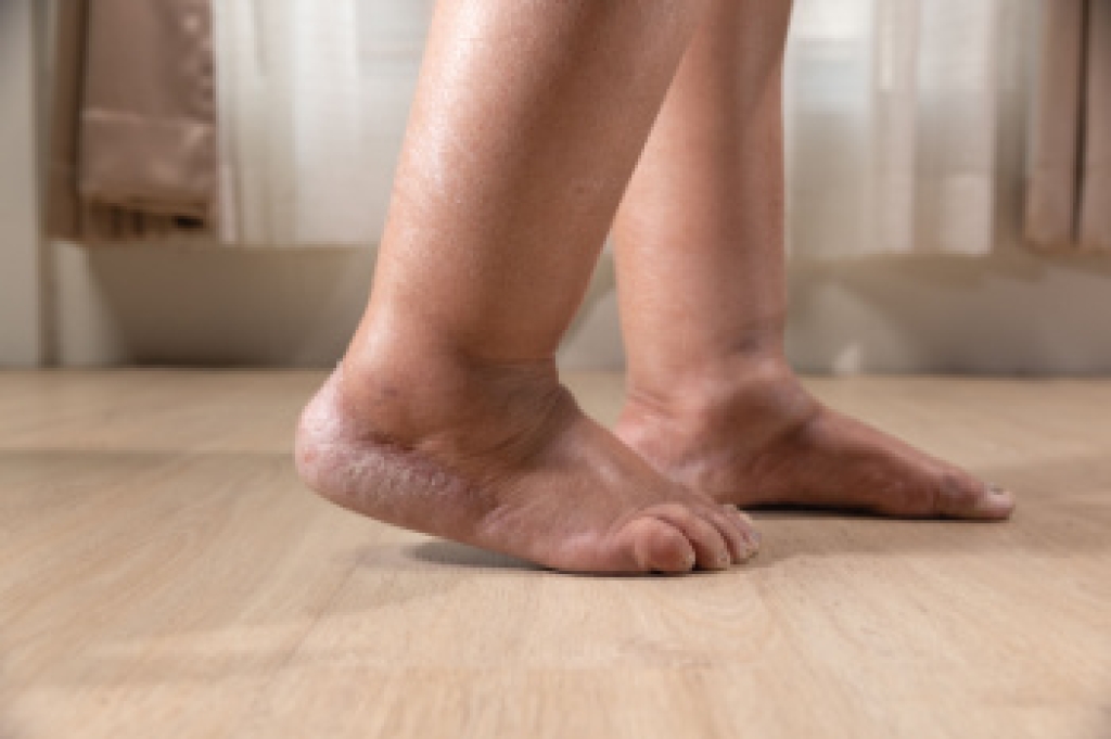 Swelling of the Feet and Fluid Buildup