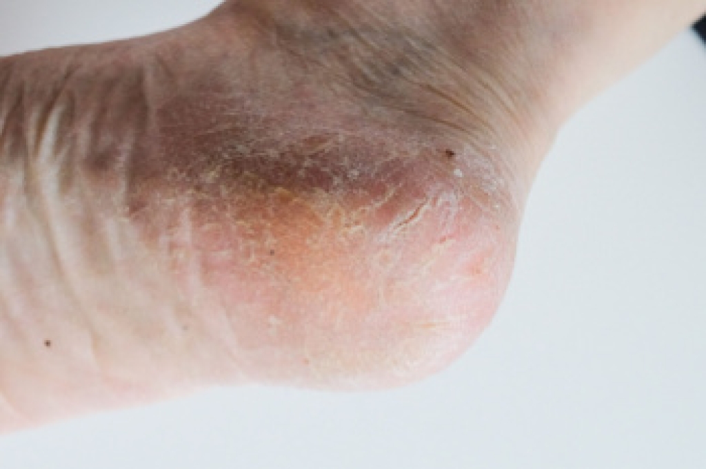 Why Do Cracked Heels Develop?