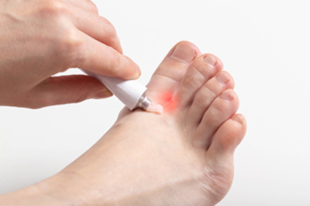 Athlete’s Foot Causes and How It Spreads