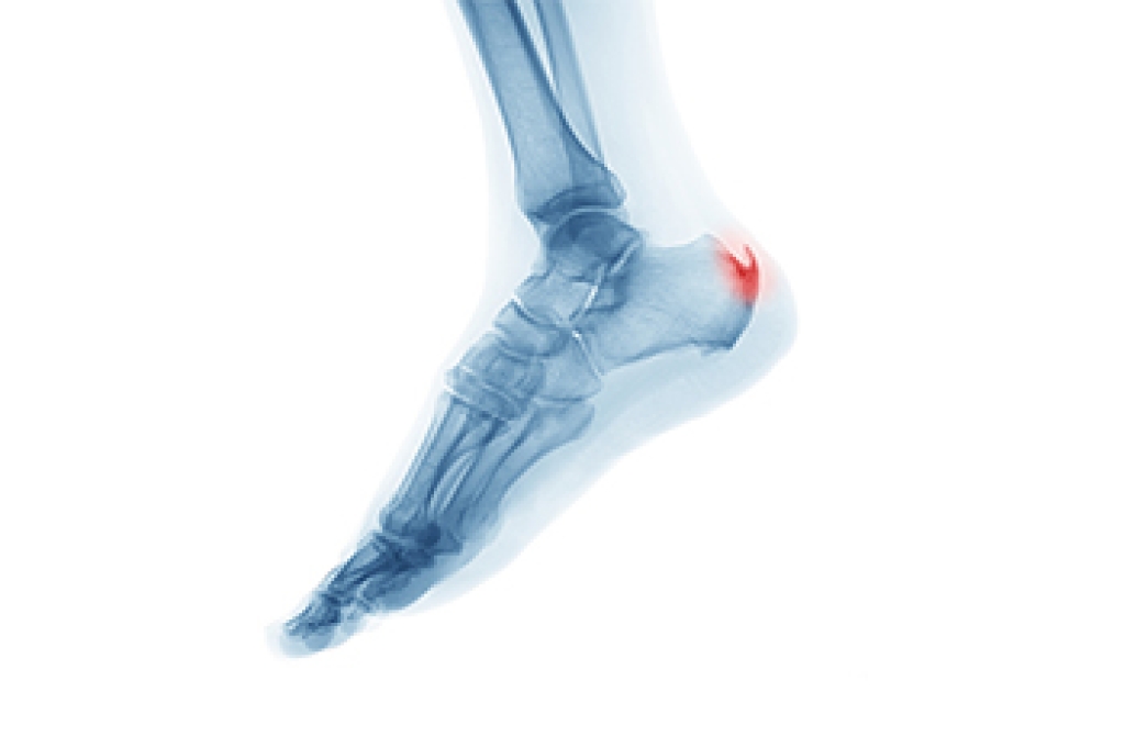 What Causes Heel Spurs?