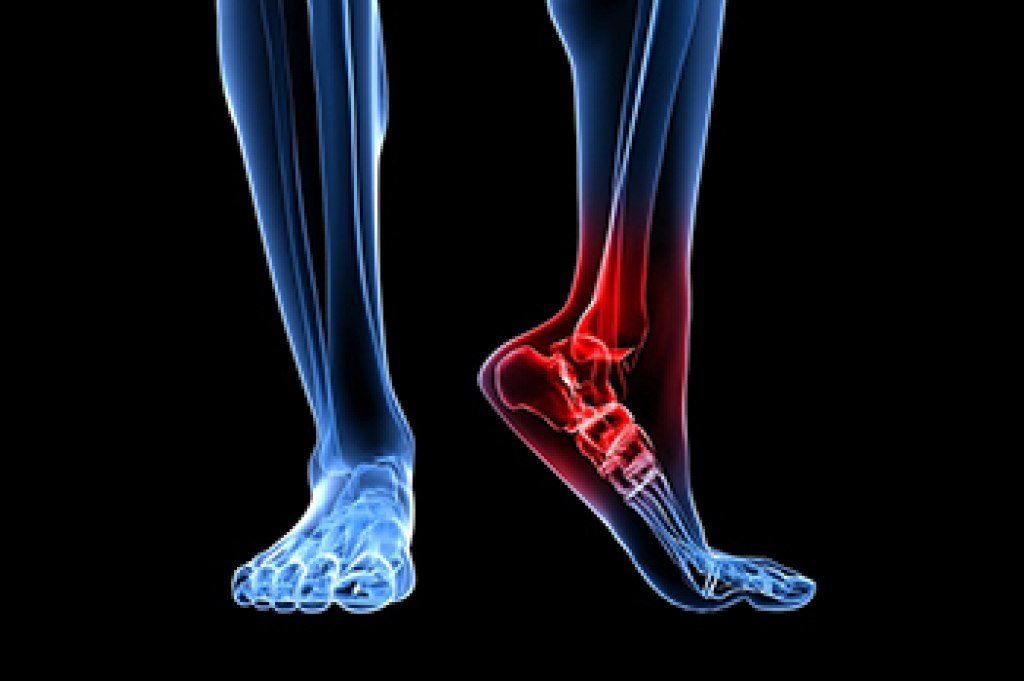 Causes and Risk Factors of Heel Fractures