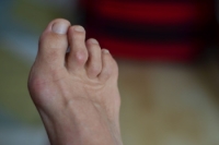 What Is a Hammertoe?
