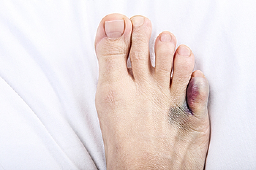 Pinky toe pain discount